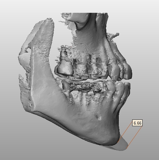 3D列印下巴手術