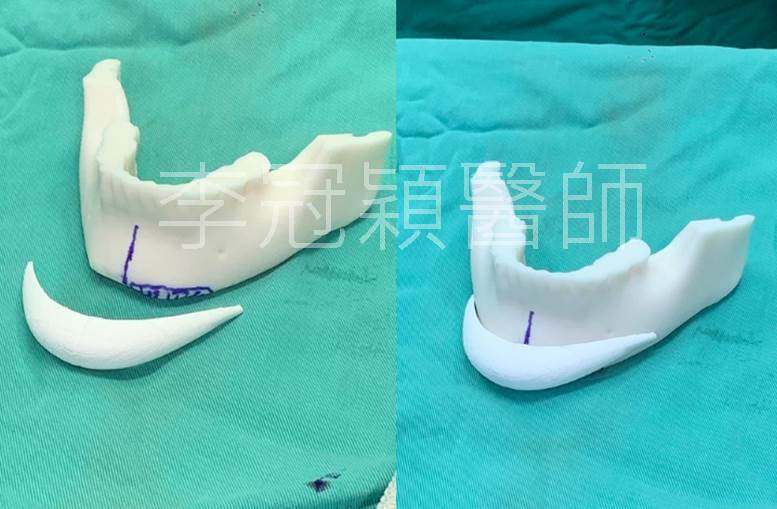 3D列印下巴手術-李冠穎醫師