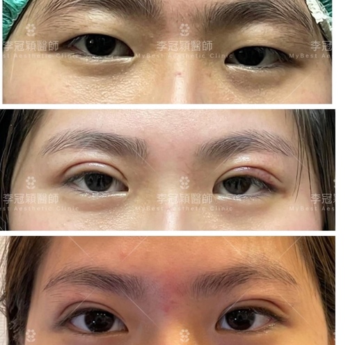 Dissatisfied-with-double-eyelid-surgery-01