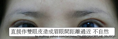 Dissatisfied-with-double-eyelid-surgery-06
