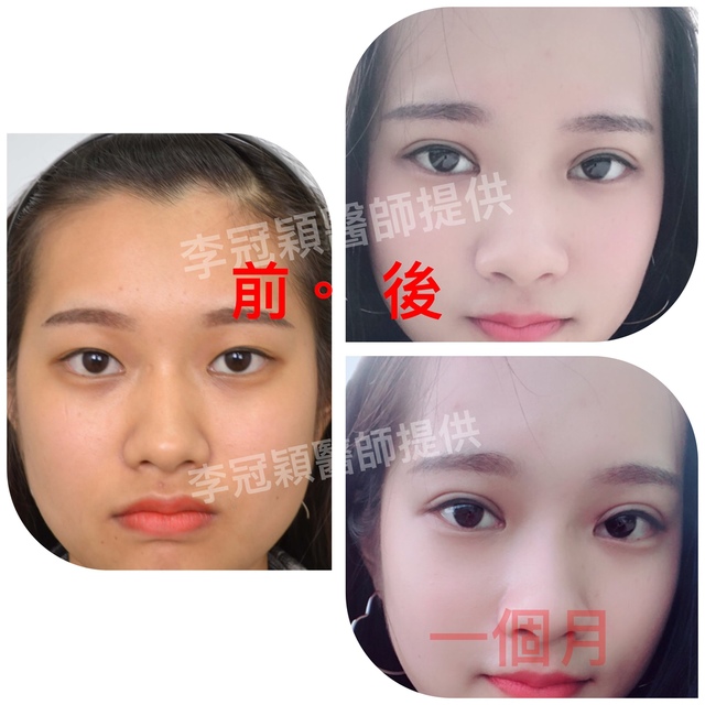 Dr.Li-Guanyings-double-eyelid-case-5