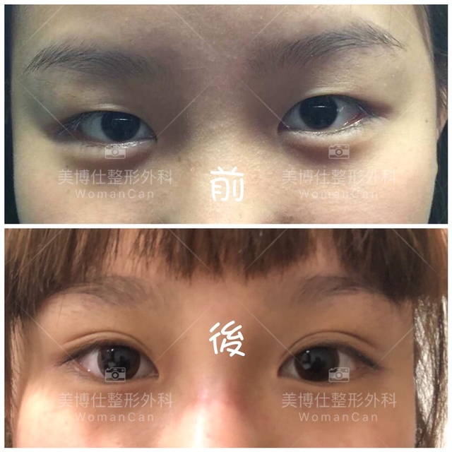Dr.Li-Guanyings-double-eyelid-case-6