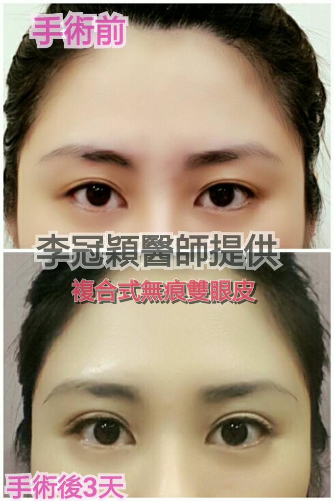 Dr.Li-Guanyings-double-eyelid-case