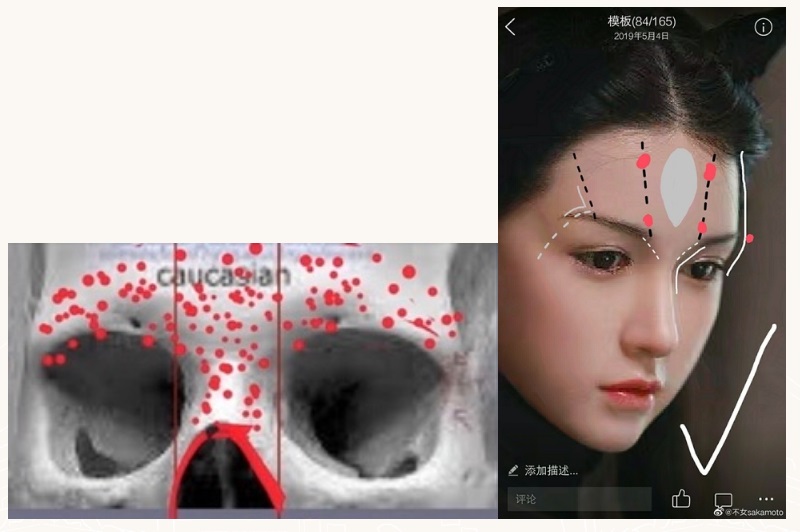 采妍整形外科診所-墊眉骨手術-台中李冠穎醫師案例