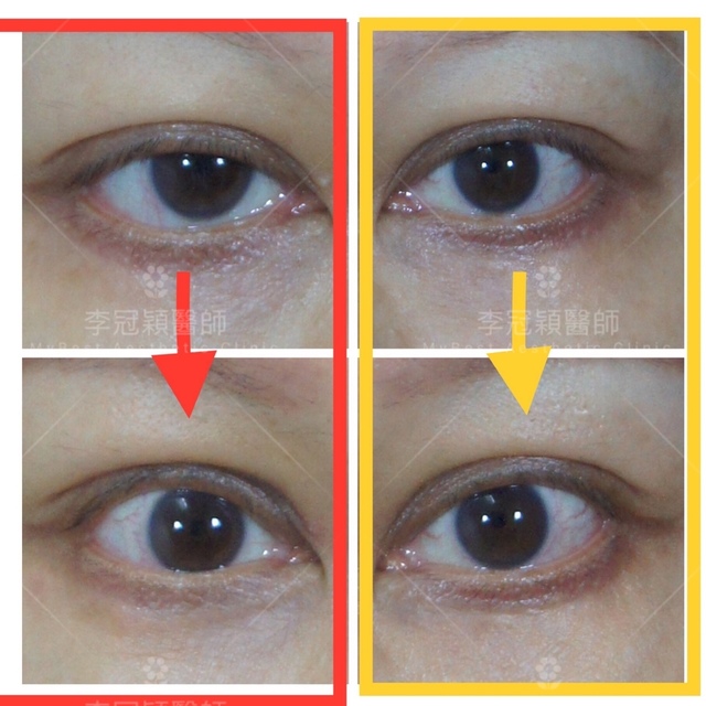 myasthenia-gravis-case-01-提眼瞼肌無力案例