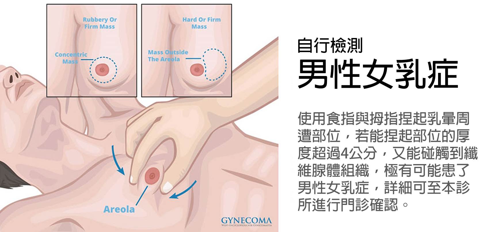 男性女乳症症狀檢測gynecomastia